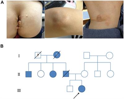 Identification and Functional Characterization of a Low-Density Lipoprotein Receptor Gene Pathogenic Variant in Familial Hypercholesterolemia